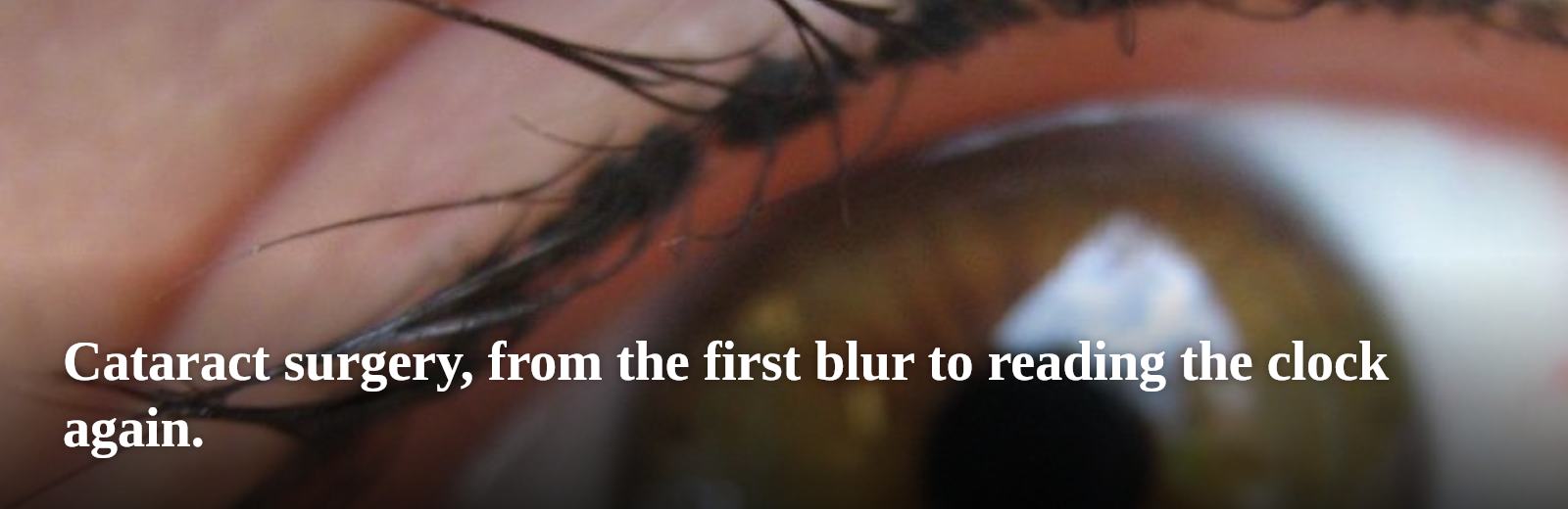 Cataract surgery, from the first blur to reading the clock again.
